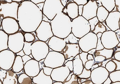 Immunohistochemical staining of human breast for Perilipin-1 using Anti-PLIN1 polyclonal antibody Immunohistochemical staining of human breast for Perilipin-1