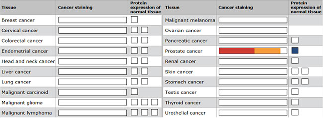 Example of antibody staining data in a range of cancer tpes Example of antibody staining data in a range of cancer types