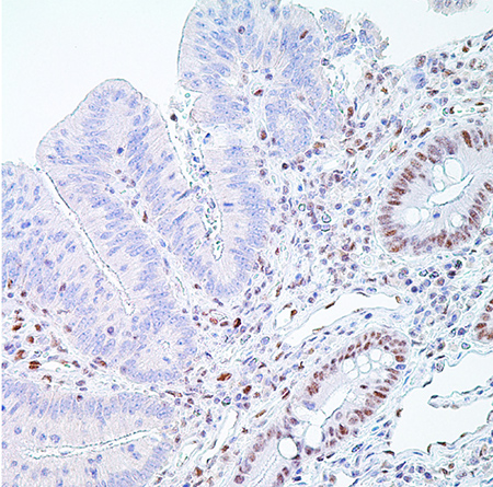 PMS2 (EPR3947†)– Note the normal nuclear labeling of the crypt epithelial cells PMS2 (EPR3947†)– Note the normal nuclear labeling of the crypt epithelial cells