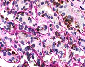 PASH T-cell-stain Tubulitis in the renal biopsy. Lymphocyte cytoplasm stains brown. Tubular borders are clearly delineated. UCHL-1/PASH 400x