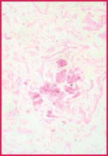 Positive fungus control A close-up view of a pinkish cellular structure positive fungus control. chromic acid-Schiff stain, 400X