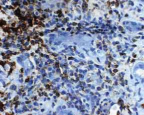 Standard lymphocyte stain It is difficult to identify borders of tubules on a standard lymphocyte stain; determining the location of the lymphocytes (outside versus inside the tubular basement membranes) can be problematic. LCA 400x