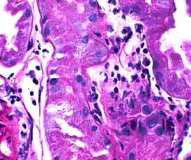 Standard PASH stain Distinguishing lymphocytes from tubular cells can be difficult on a standard PASH stain. PASH 400x