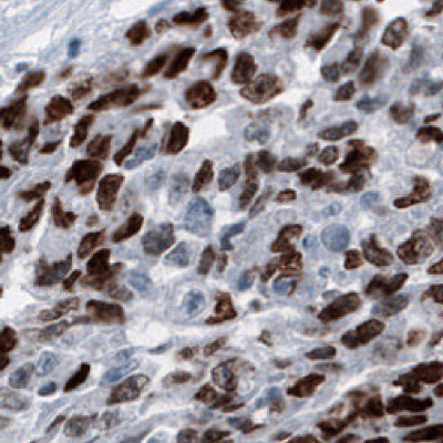 IHC Staining of Embryonal Testis Carcinoma Germinal Cells Using Anti-SALL4 Monoclonal Antibody Immunohistochemical staining of human germinal cells in embryonal testis carcinoma using Anti-SALL4 monoclonal antibody (Product No. AMAb91769) showing nuclear positivity.