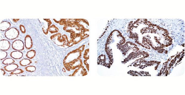 结肠癌的Cell Marque™ IVD抗体染色