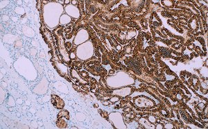 IHC staining of clinical tissue with a Cell Marque™ TROP2 antibody