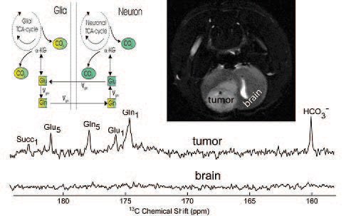 A mixture of 16mM 1-13C-maleate and 8mM 1-13C-succinate was injected into the carotid artery of a 9L tumor- bearing rat. Ex vivo13C high resolution NMR spectra at 11.7T were collected after 1 hour of succinate metabolism from brain and tumor tissues. Glutamine and glutamate C1 and C5 carbons are enriched with 13C label from C1 of succinate in tumors. The order-of-magnitude contrast ratio between tumor and brain suggests that hyperpolarized 1-13Csuccinate could be a highly potent molecular imaging agent.