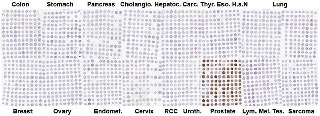 Representation of TMA cohort