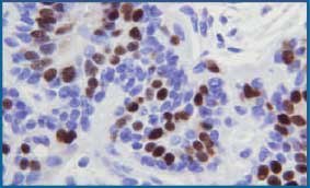 Microwave fixed breast tissue stained with IHC for estrogen receptor protein. Tissue shows minimal background staining. 400X Microwave fixed breast tissue stained with IHC for estrogen receptor protein. Tissue shows minimal background staining. 400X
