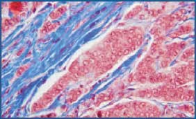 Microwave fixed breast tissue stained with Masson’s trichrome. Note the crisp nuclear detail. 200X Microwave fixed breast tissue stained with Masson’s trichrome. Note the crisp nuclear detail. 200X