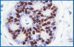 Microwave fixed breast tissue stained with IHC for progesterone receptor protein. 400X Microwave fixed breast tissue stained with IHC for progesterone receptor protein. 400X