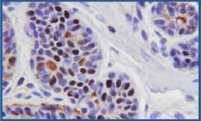 Routinely fixed and processed breast tissue stained with IHC for estrogen receptor protein. Some background staining is noted in intercellular areas and ductal lumens. 400X Routinely fixed and processed breast tissue stained with IHC for estrogen receptor protein. Some background staining is noted in intercellular areas and ductal lumens. 400X