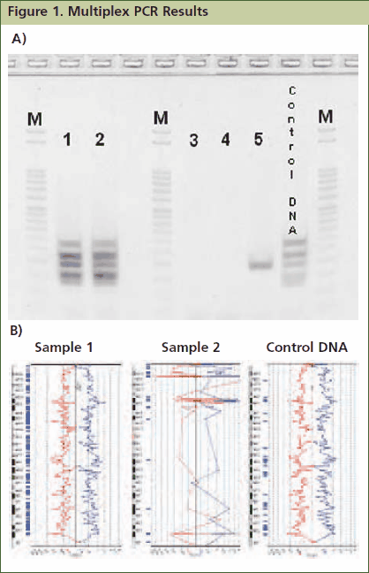 Approximately 1mg of tissue was collected from five FFPE tissue samples followed by processing with the GenomePlex Tissue Whole Genome Amplification Kit (Product No. WGA2) as outlined in the technical bulletin. (A) 5 μL of undiluted WGA2 tissue lysate was subjected to multiplex PCR amplification as outlined below, and 5 μL of each reaction was resolved on a 4% agarose gel (Invitrogen # G6000-04). The 100 bp DNA ladder (Invitrogen catalog # 15628-019) was used as a size standard. All five bands were amplified in lanes 1 and 2 indicating that these FFPE tissue lysates contain high quality genomic DNA, whereas lanes 3, 4 and 5 contain low quality DNA since all, or most, of the multiplex PCR fragments were not amplifiable. Similar results were observed when purified DNA or amplified WGA product derived from these FFPE tissues were used directly in the multiplex qPCR assay (data not shown). (B) aCGH was performed to demonstrate a correlation between the multiplex PCR results and aCGH performance. 1 μg of WGA2 products were used for BAC aCGH analysis using PerkinElmer’s Spectral Labeling Kit and SpectralChip™ 2600 array platform per manufacturer’s recommendations. The ideograms below are representative of the data obtained with this sample set. They were generated using PerkinElmer’s Spectralware™ BAC array analysis software. High quality array statistics and QC metrics were obtained with samples 1 and 2, where as samples 3, 4 and 5 produced irregular array statistics and poor QC metrics. Test and control hybridization samples are labeled in Figure B. Approximately 1mg of tissue was collected from five FFPE tissue samples followed by processing with the GenomePlex Tissue Whole Genome Amplification Kit (Product No. WGA2) as outlined in the technical bulletin. (A) 5 μL of undiluted WGA2 tissue lysate was subjected to multiplex PCR amplification as outlined below, and 5 μL of each reaction was resolved on a 4% agarose gel (Invitrogen # G6000-04). The 100 bp DNA ladder (Invitrogen catalog # 15628-019) was used as a size standard. All five bands were amplified in lanes 1 and 2 indicating that these FFPE tissue lysates contain high quality genomic DNA, whereas lanes 3, 4 and 5 contain low quality DNA since all, or most, of the multiplex PCR fragments were not amplifiable. Similar results were observed when purified DNA or amplified WGA product derived from these FFPE tissues were used directly in the multiplex qPCR assay (data not shown). (B) aCGH was performed to demonstrate a correlation between the multiplex PCR results and aCGH performance. 1 μg of WGA2 products were used for BAC aCGH analysis using PerkinElmer’s Spectral Labeling Kit and SpectralChip™ 2600 array platform per manufacturer’s recommendations. The ideograms below are representative of the data obtained with this sample set. They were generated using PerkinElmer’s Spectralware™ BAC array analysis software. High quality array statistics and QC metrics were obtained with samples 1 and 2, where as samples 3, 4 and 5 produced irregular array statistics and poor QC metrics. Test and control hybridization samples are labeled in Figure B.