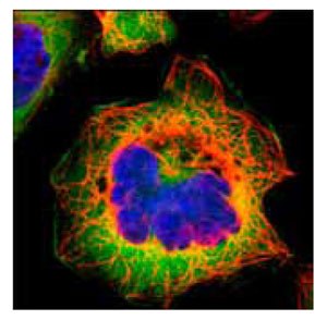 <a href="/product/SIGMA/HPA006461">Product No. HPA006461</a>: Immunofluorescent staining of human cell line A-431 shows positivity in cytoplasm. Anti-FASN