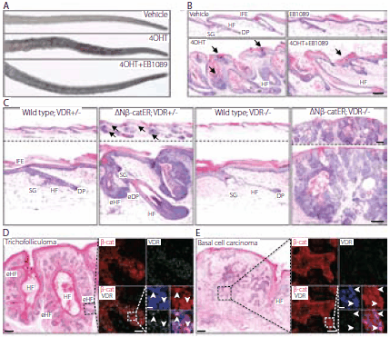 VDR modulates β-catenin induced skin tumors. (A, B) K14ΔNβ-cateninER (D4) transgenic mice were treated with vehicle, 4-hydroxy-Tamoxifen (4OHT), EB1089 or 4OHT+EB1089 for 21 days. (A) Macroscopic appearance of tails. (B) Hematoxylin and eosin (H&E) stained tail skin sections. Arrows indicate parakeratosis and increased cornified layers. (C) H&E stained tail skin sections of wild type and K14ΔNβ-cateninER (D4) transgenic mice that were heterozygous (+/–) or homozygous (–/–) null for VDR, following 4OHT treatment for 21 days. Arrows indicate ectopic hair follicle formation. eHF: ectopic hair follicles; DP: dermal papilla; eDP: ectopic dermal papilla. (D, E) Human trichofolliculoma (D) and infiltrative basal cell carcinoma (E). Serial sections were stained with H&E or immunolabelled for β-catenin (red) and VDR (green) with Hoescht counterstain (blue). Immunolabelling corresponds to boxed regions of H&E stained sections. Arrowheads show nuclear β-catenin and VDR. Scale bars: 100 μm (B–E), 50 μm (inserts in d, e), 10 μm (Hoescht staining inserts d,e). Copyright © Palmer, H.G. et al., PLoS ONE, 3(1), e1483. This image is from an open-access article distributed under the terms of the Creative Commons Attribution License VDR modulates β-catenin induced skin tumors