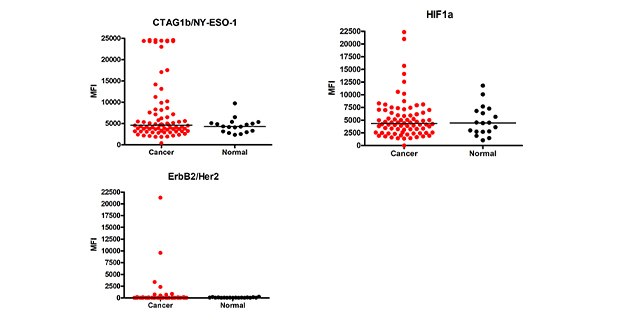 Graph showing data for cancer autoantibody analysis. Using MILLIPLEX® Human Cancer Autoantibody Panel Cat. No. HCABMAG-13K, the MFI (Median Fluorescence Intensity) values of the cancer autoantibody biomarkers were determined in cancer (breast, colorectal, ovarian, lung, prostate) (n=78) and healthy control (n=18) serum samples (samples diluted at 1:100).
