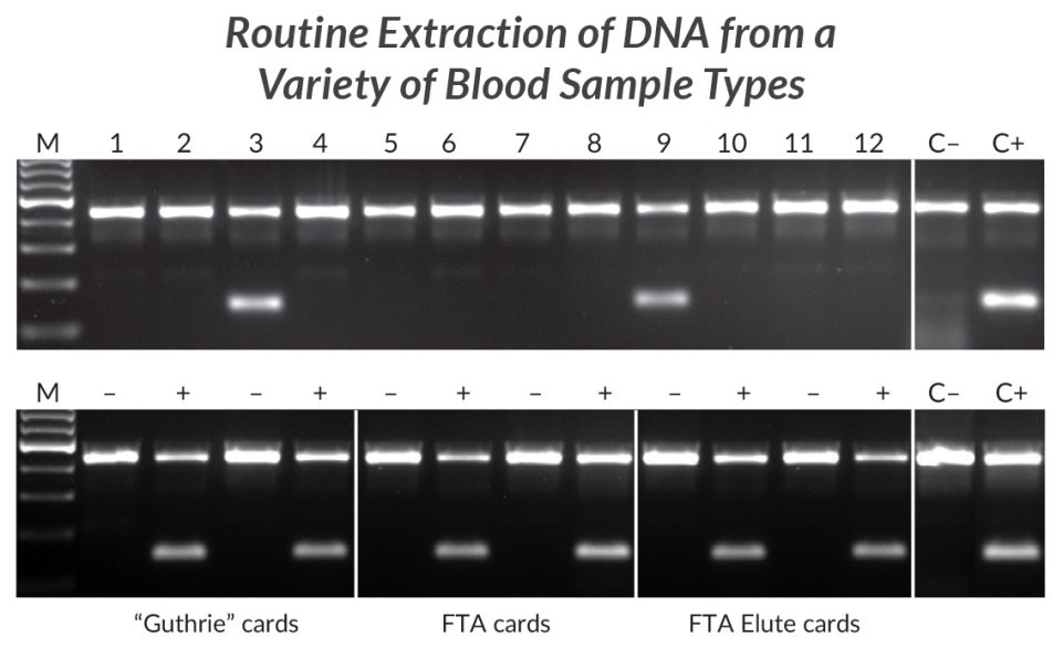Extraction and amplification of DNA from different blood sample types for detection of the HLA-B*27 allele. DNA was extracted from 12 human EDTA blood samples with KAPA Express Extract (top panel). 2 μL of each extract was added directly to a 25 μL PCR containing KAPA2G Robust HotStart ReadyMix and two primer sets. The internal control primer set targets a 429 bp fragment of the beta globin gene, whereas the second primer set targets a 141 bp fragment of the HLA-B*27 locus in a sequence-specific manner. Two of the 12 individuals tested positive for the HLA-B*27 allele associated with ankylosing spondylitis. Lanes C- and C+ represent HLA-B*27 negative and positive controls respectively (1 ng purified human genomic DNA as template). DNA was extracted from “Guthrie” cards, FTA cards, or FTA Elute cards (bottom panel) spotted with blood of individuals confirmed to be HLA-B*27 positive (+) or negative (-). DNA extraction and amplification conditions and controls (C- and C+) were the same as for the top panel. Extraction and amplification of DNA from different blood sample types for detection of the HLA-B*27 allele.