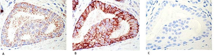 Detection of HER2 receptor and HER2/HER3 heterodimers in FFPE breast cancer tissue