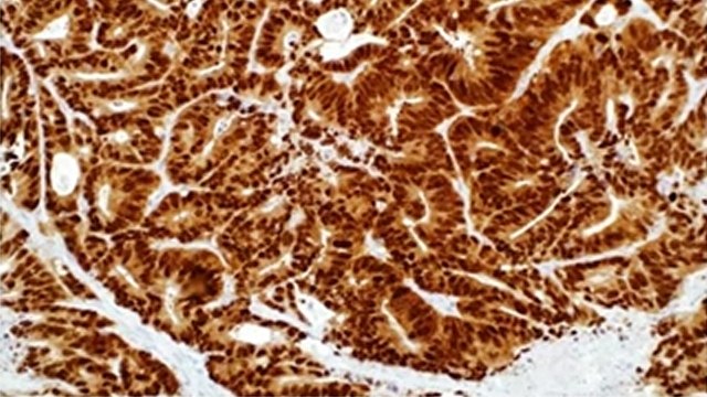 Colorectal Cancer and Immunohistochemistry Webinar